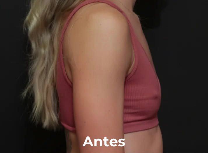 EscoteLift – Parches reafirmantes para el pecho